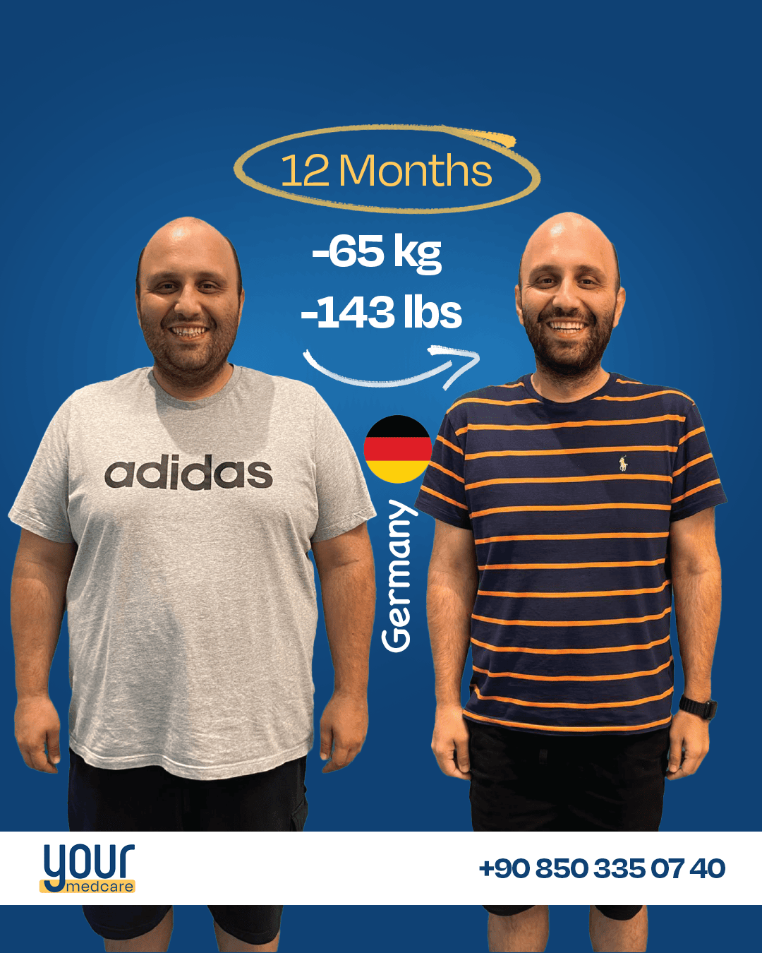 Man lost 65 kg after weight loss 